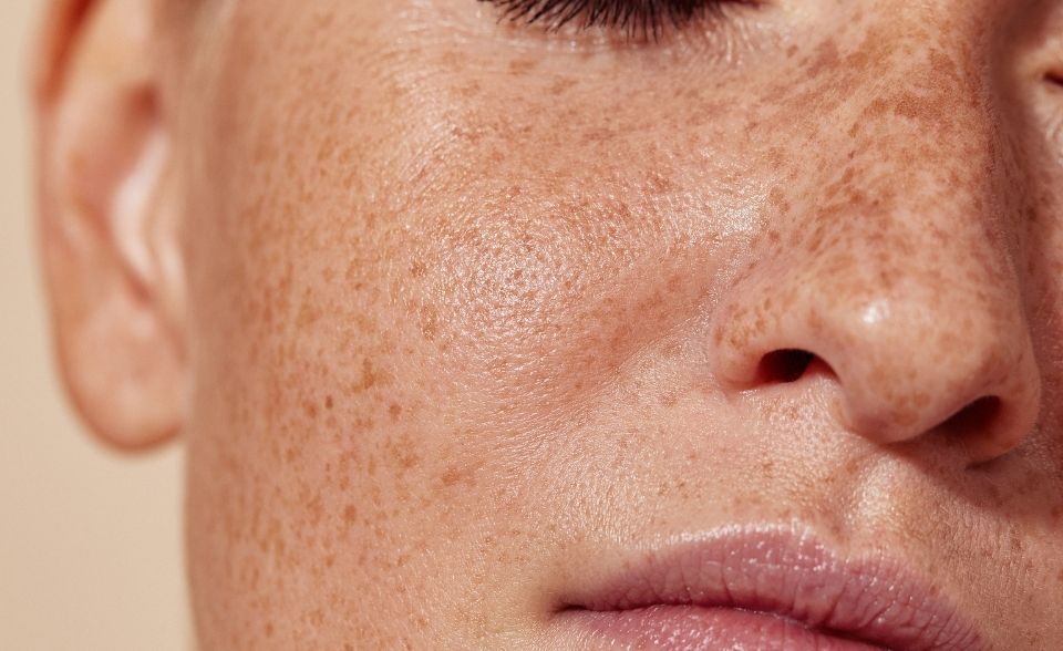 Pigment, Redness & Vein Reduction