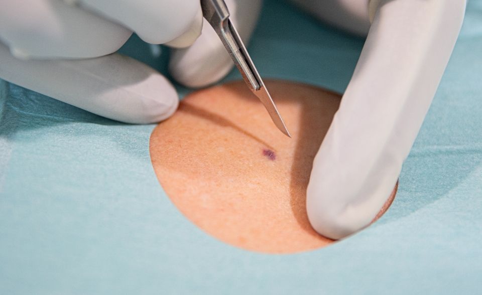Skin Biopsy