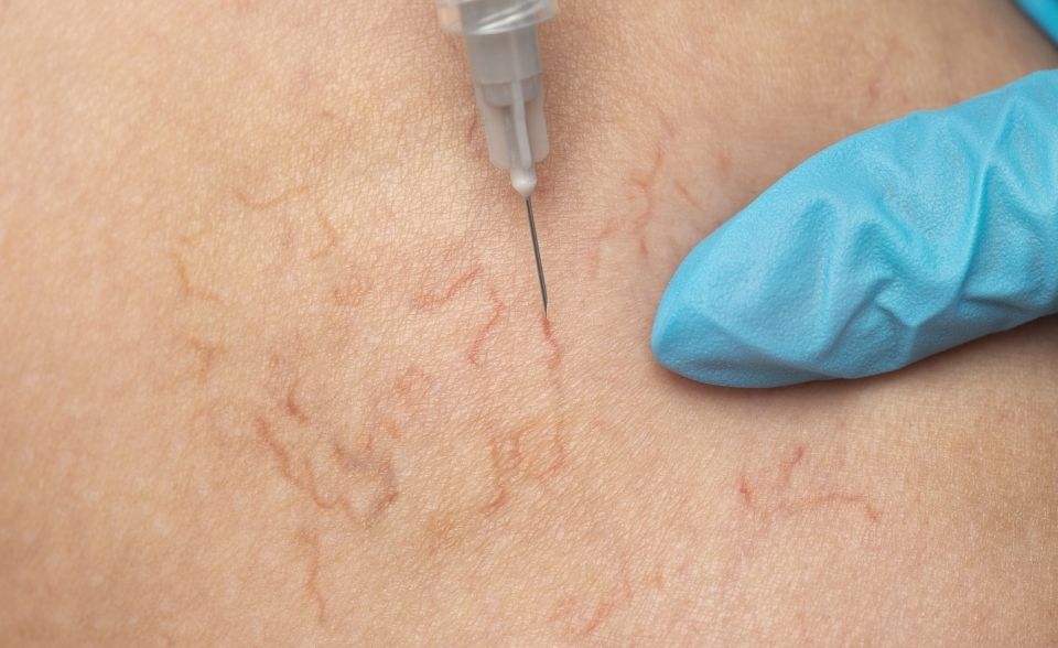 Endovenous Ablation (EVA)